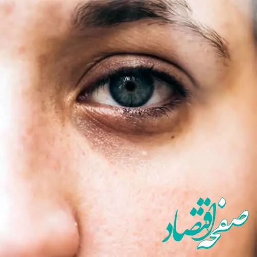علت بروز گودی زیرچشم و روش های خانگی درمان آن