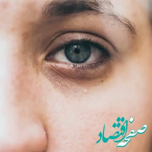 علت بروز گودی زیرچشم و روش های خانگی درمان آن