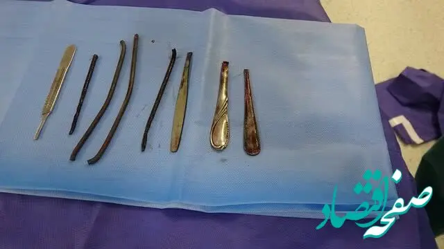 فوری؛ مرد شیشه‌ای در کرمانشاه ۴ دسته قاشق و ۴ شی فلزی دیگر را بلعید و زنده ماند! 