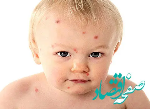 وضعیت بیماری آبله مرغان در کشور به چه صورت است؟