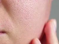 با این روش منافذ باز پوست را کوچک تر کنید