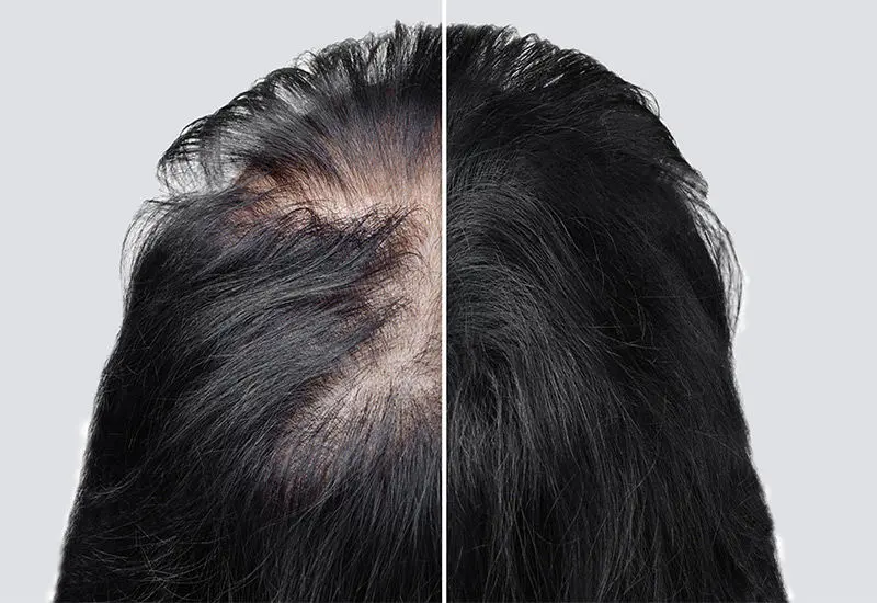 همه چیز در رابطه با دو آمپول معروفی که برای درمان ریزش مو بسیار تبلیغ می شوند