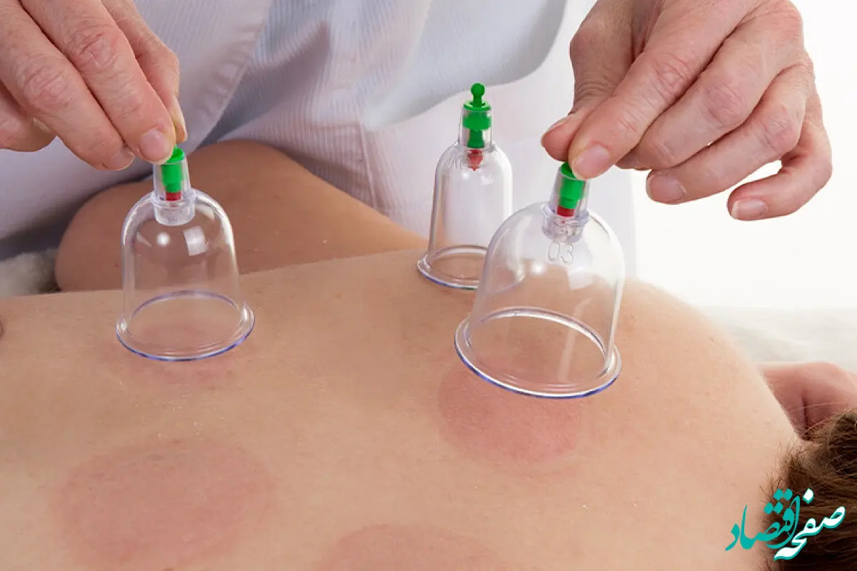 تقویم حجامت سال ۱۴۰۳ + روزهای مناسب حجامت در ۱۴۰۳ و روزهای منع حجامت در تقویم ۱۴۰۳