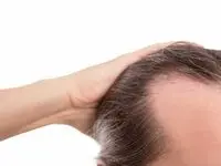 چگونه تغذیه بر شوره سر اثر می‌گذارد؟