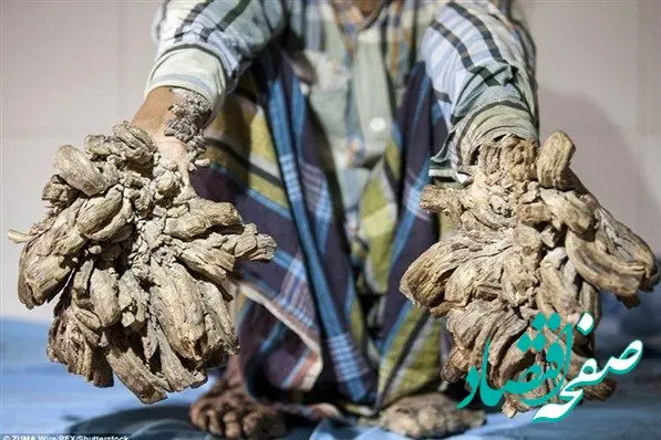 بیماری نادر مرد درختی؛ علت، علائم و تاثیرات آن بر زندگی فرد | بیماری مرد درختی: علائم و علت‌های نادر آن | همه چیز برای بیماری نادر مرد درختی