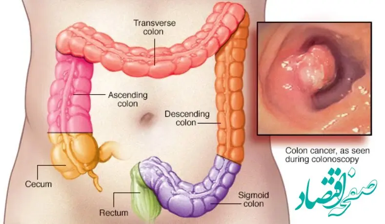 حتما بخوانید | افزایش سرطان روده بزرگ در میان جوانان