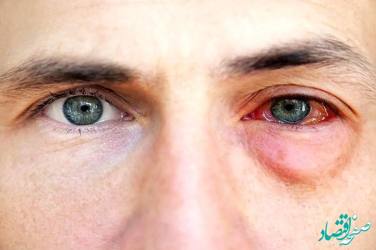 کرونای چشمی چه عوارضی دارد؟ + مدت زمان دوره ی نقاهت